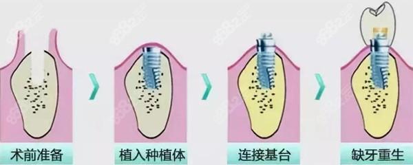 2025年韩国种植牙品牌价格对比及推荐：费用多少，性价比如何，哪种牌子最划算？(图1)