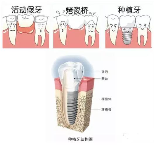 瑞典Astra与美国皓圣种植牙对比：价格价格表，质量评测及选择指南(图1)