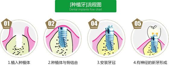 韩国进口Cowell种植牙价格解析：一颗2025元起，价目表及价格表一览(图1)